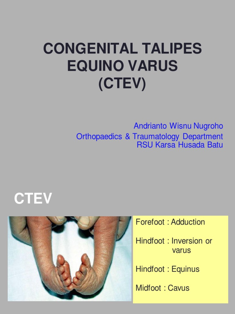 Treatment of Congenital Talipes Equino Varus (CTEV) Through Ponseti