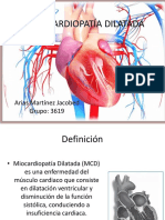 Miocardiopatía Dilatada