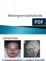 Meningoencephalocele