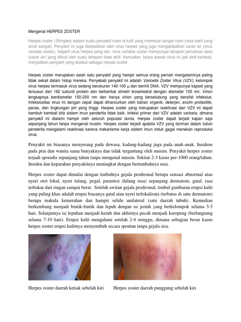 herpes di punggung kanan