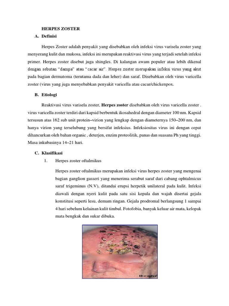 Herpes Zoster