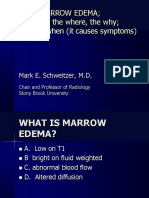 MR of Marrow Edema