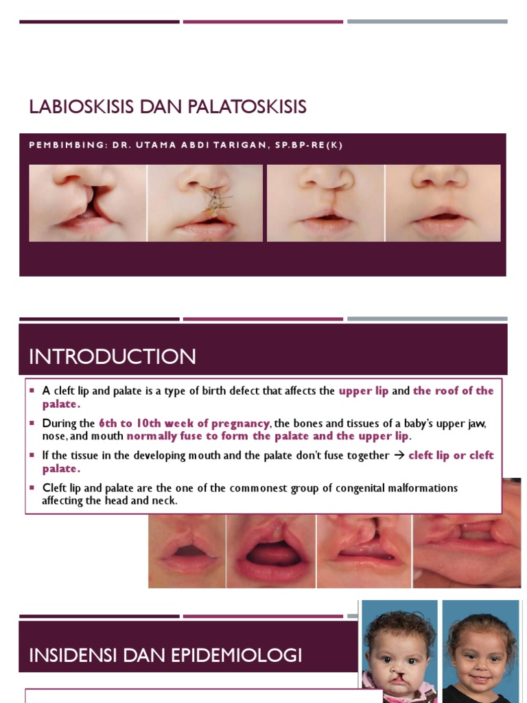 Cleft Lip and Palate Overview | PDF | Congenital Disorder | Medical ...