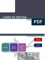 Caries en Dentina