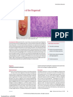 Ulcerated Nodule of The Fingernail