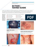 BJFM March 14 p22-23 Tinea Infection PDF