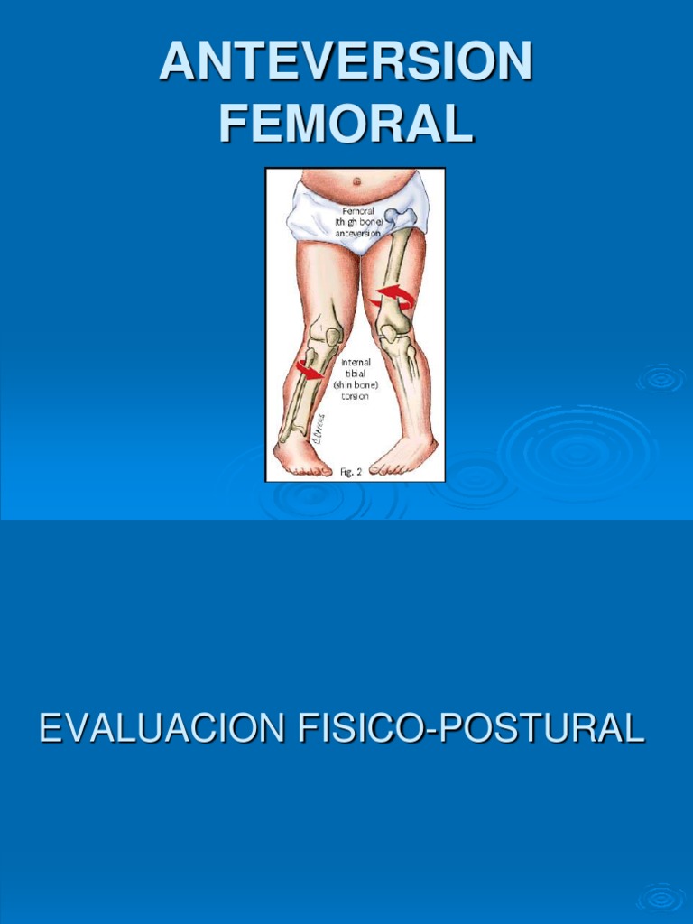 Anteversion Femoral | PDF | Sistema musculoesquelético | Naturaleza