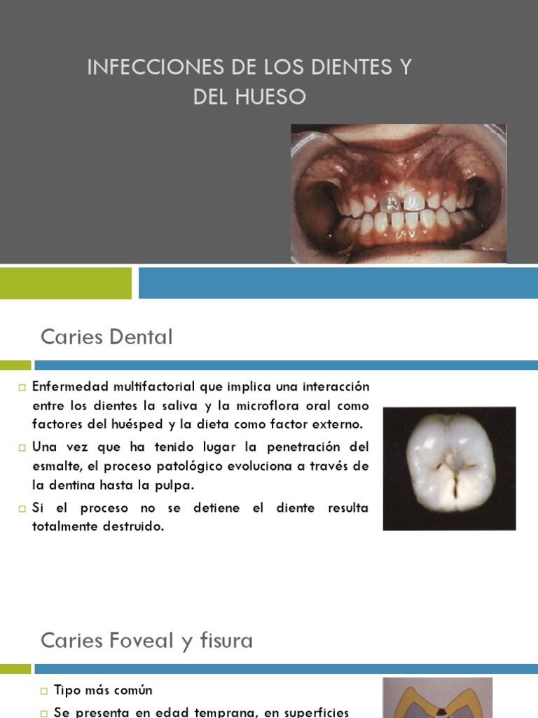 Infecciones de Los Dientes y Del Hueso | Diente | Medicina