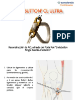 Endobutton CL Ultra TECNICA v2