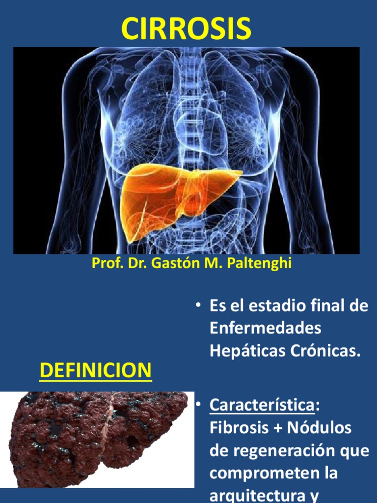Cirro Sis Cirrosis Sistema exocrino