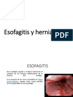 Esofagitis y Hernia Hiatal