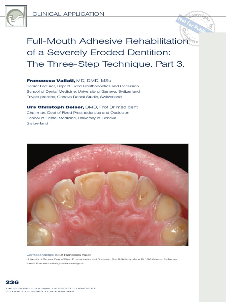 FullMouth Adhesive Rehabilitation of A Severely Eroded Dentition The