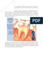 A periodontite é a fase da doença periodontal que teve início no processo inflamatório na gengiva.docx