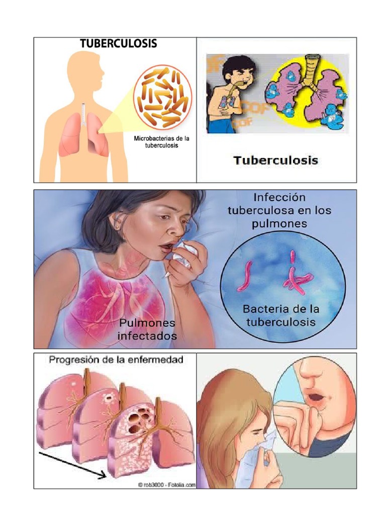 Dibujos Tuberculosis Bienestar