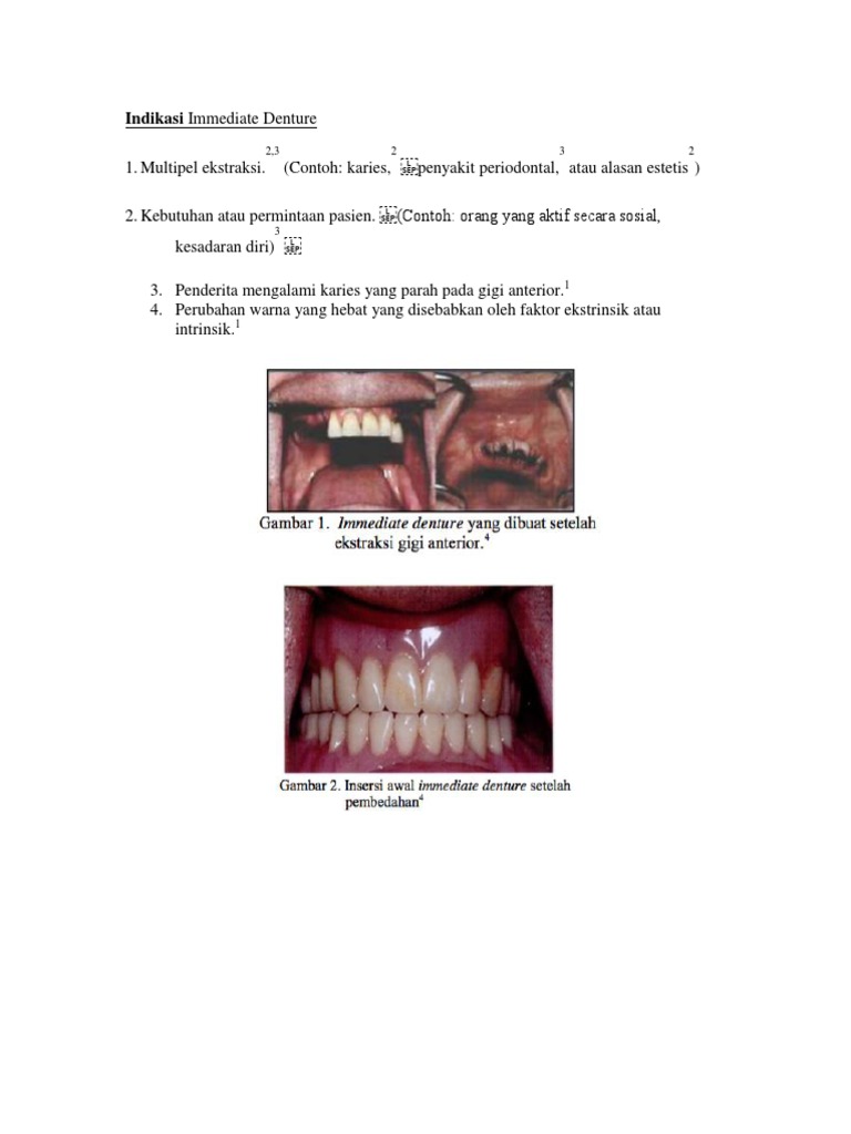 Indikasi Kontraindikasi Immediate Denture PDF