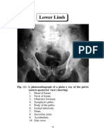 Lower Limb: Fig. (1) : A Photoradiograph of A Plain X Ray of The Pelvis (Antero-Posterior View) Showing