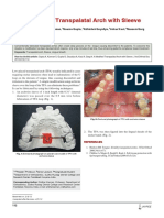 A Modified Transpalatal Arch With Sleeve