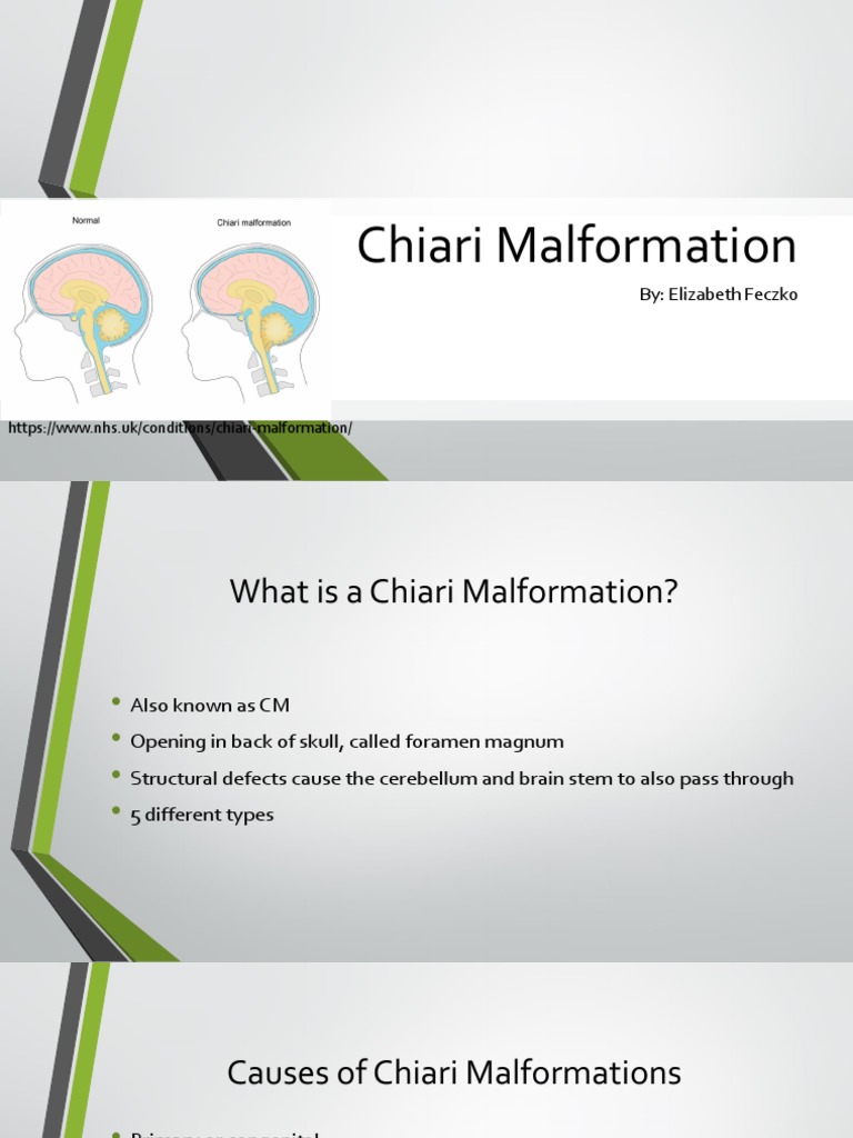 Chiari Malformation | PDF | Diseases And Disorders | Clinical Medicine