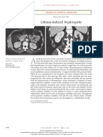 Lithium Induced Nephropathy