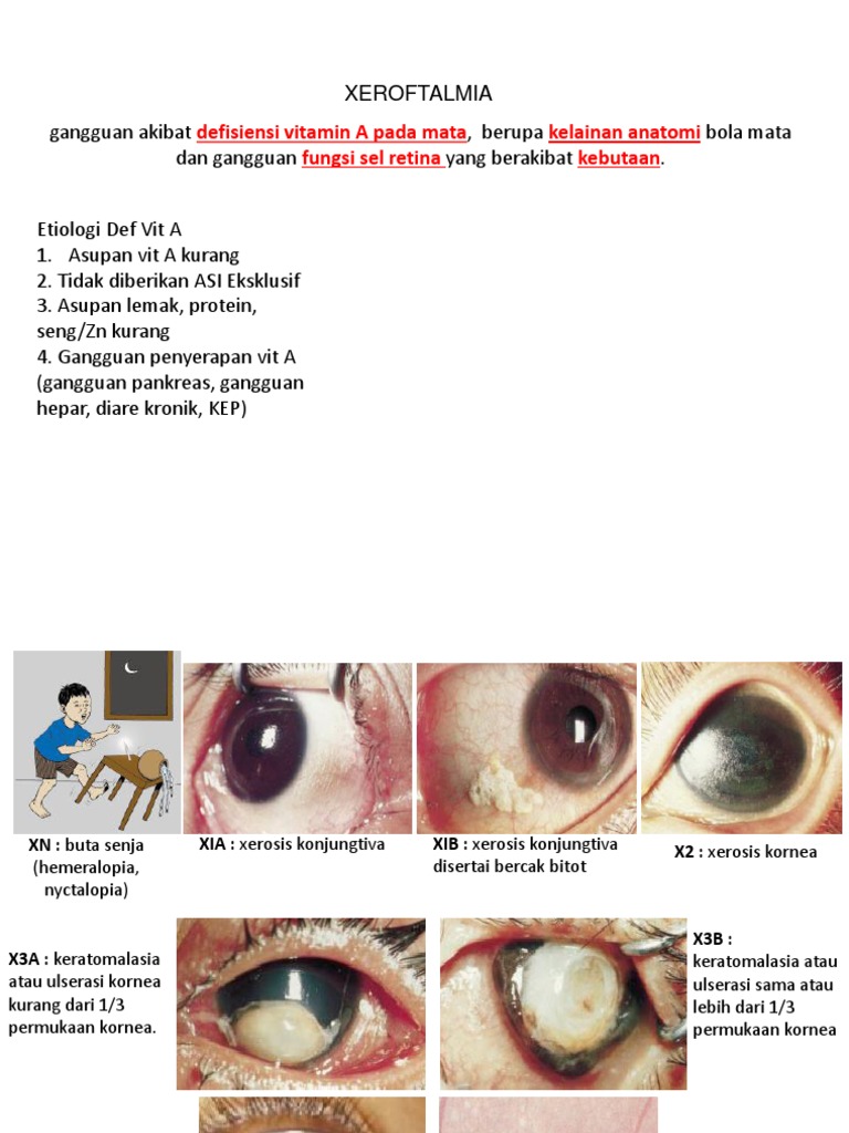 xeroftalmia ppt singkat