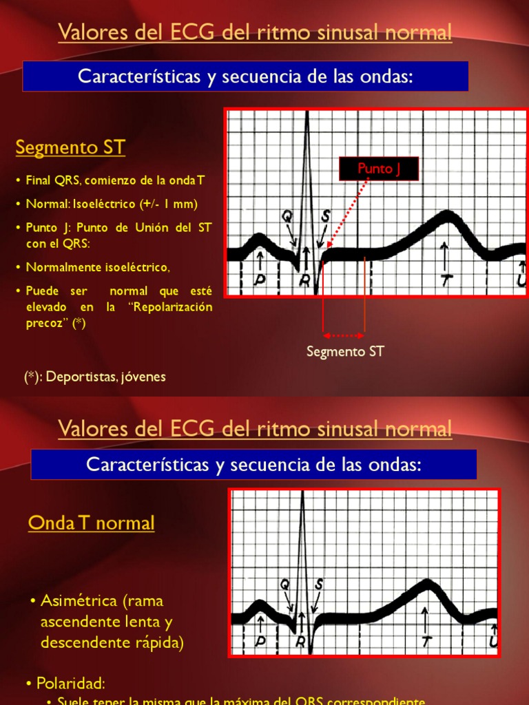 Alteraciones del Segmento ST en ECG | PDF | Electrocardiografia ...
