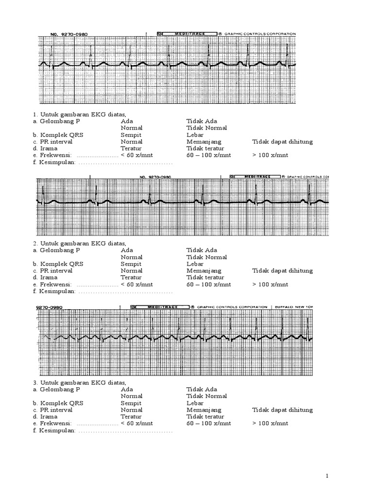 Unduh 91 Gambar Gelombang Ekg Normal  