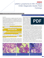 Burkitt's Lymphoma in HIV-Positive Child: Diagnostic Ascitic Fluid Cytology