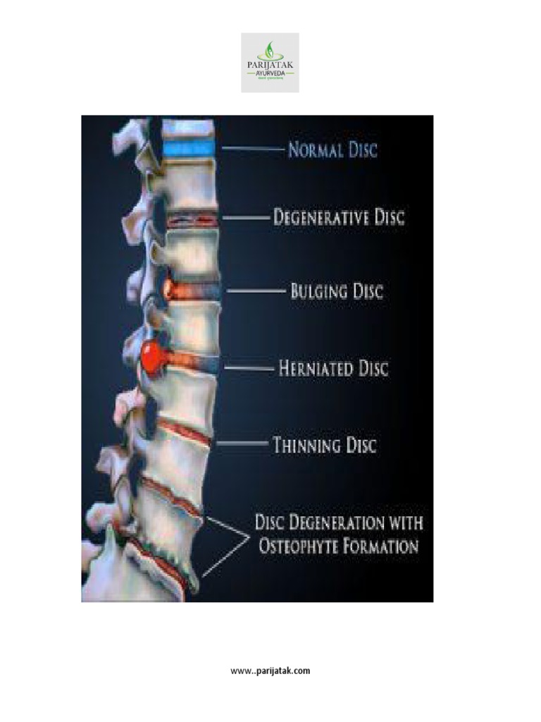 Ayurvedic Treatment of Cervical Disc Bulge PDF Vertebral Column