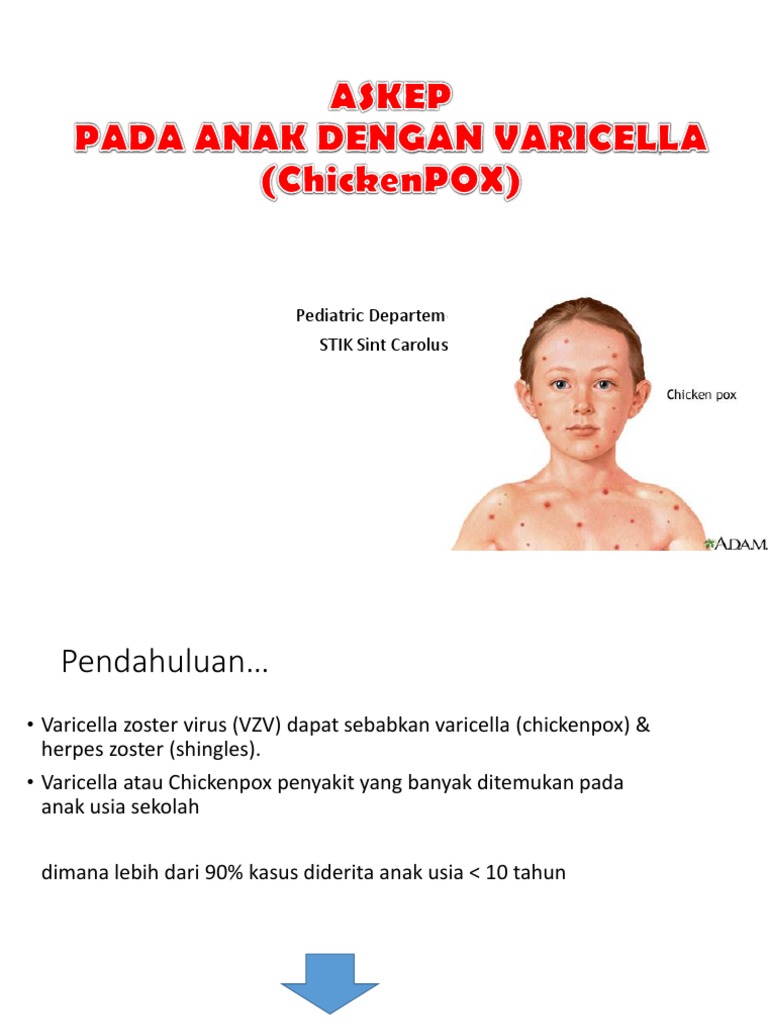 Penanganan Varicella pada Anak | PDF