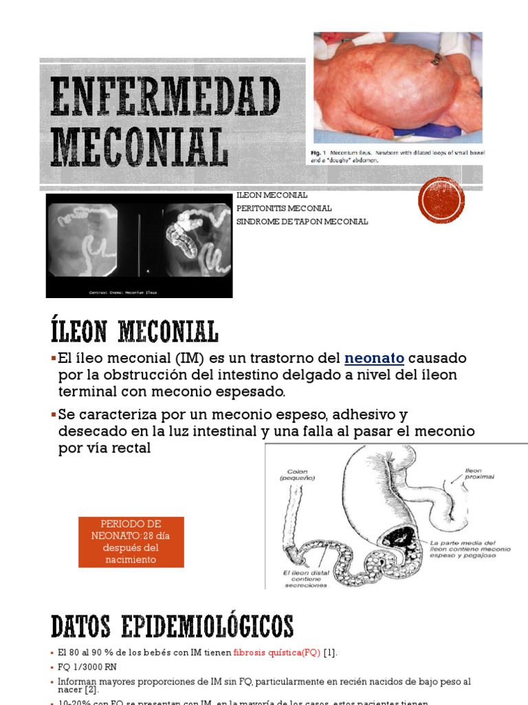 Íleo Meconial: Causas y Tratamiento | PDF | Gastroenterología | Rtt