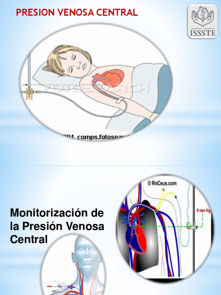 Presion Venosa Central 2017 Vena Ventrículo (Corazón)