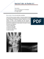 Caso Clinico Fx de Radio Distal y Escafoides