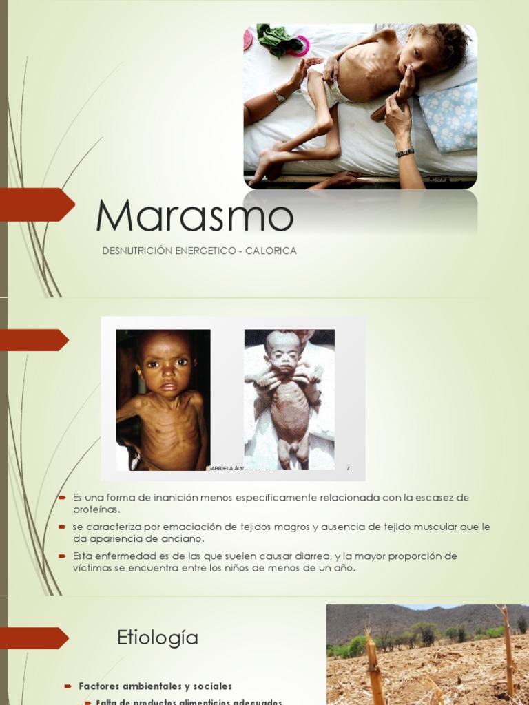 ¿Cómo saber si un niño tiene marasmo