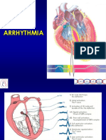 Arrhythmia