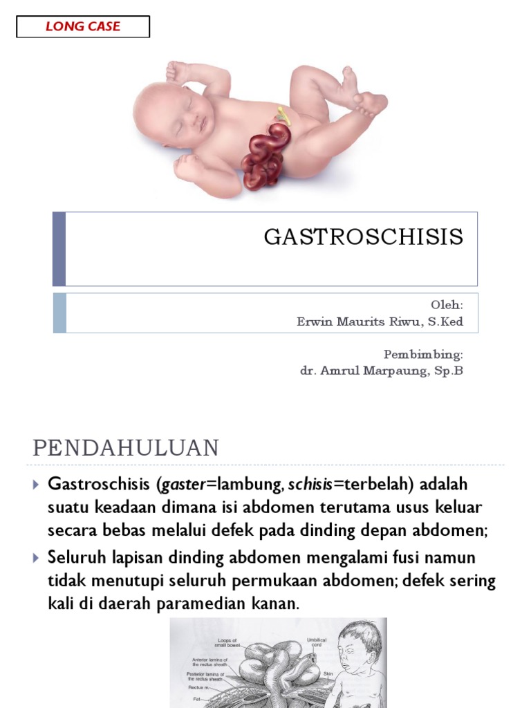 Gastroschisis PDF