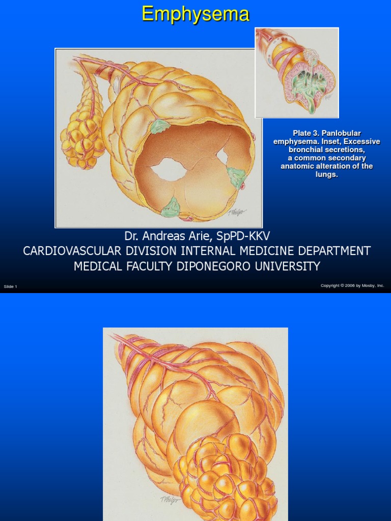 Emphysema - Kuliah Cirebon | PDF | Chronic Obstructive Pulmonary ...