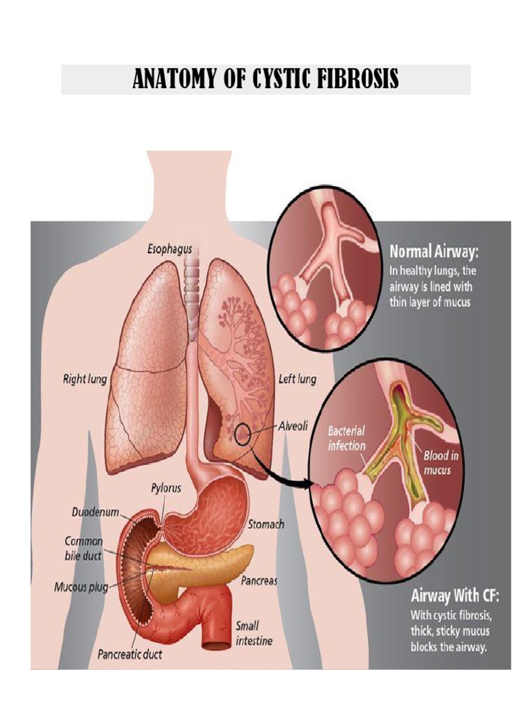 Anatomy of Cystic Fibrosis Effects | PDF | Mucus | Anatomy