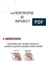 Hipertrofie Si Infarct