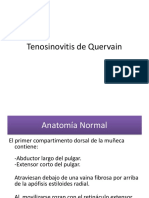 Tenosinovitis de Quervain