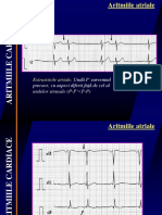 Aritmiile Atriale 2011