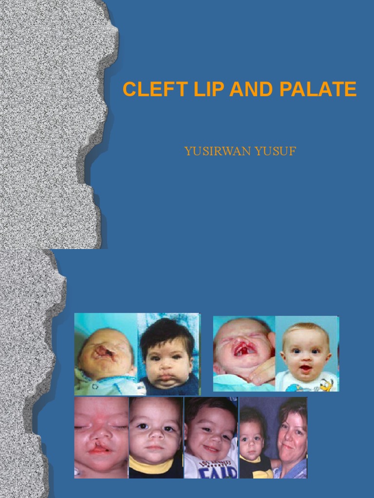 Cleft Lip and Palate Overview | PDF | Congenital Disorder | Human Nose