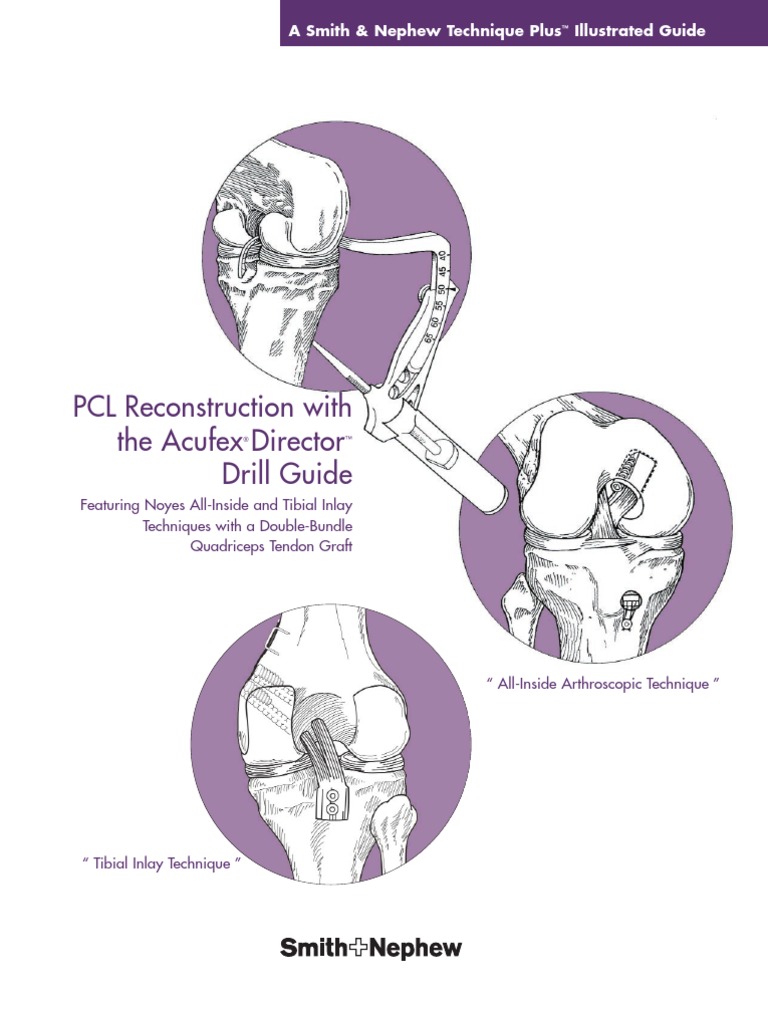 PCL Reconstruction with Acufex Guide | PDF