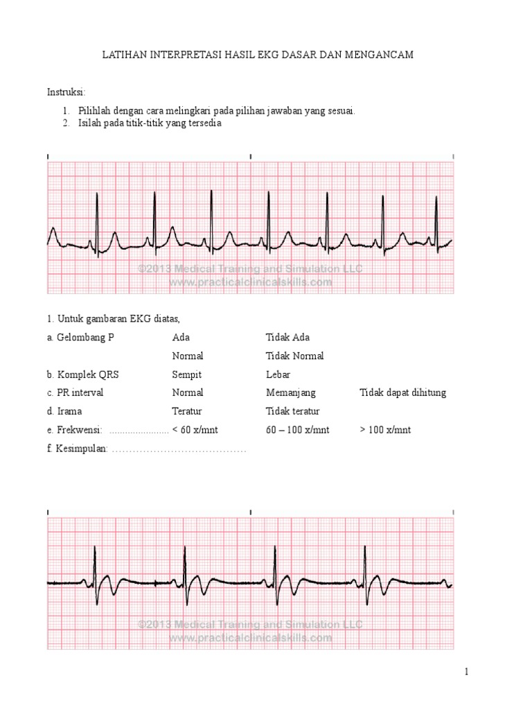 Unduh 420 Koleksi Gambar Ekg Normal Dan Tidak Normal  