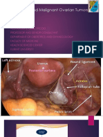 (#5) Benign and Malignant Ovariaan Tumors