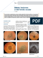 Pigmentadas Del Fondo Ocular: Nevus Coroideos: Lesiones