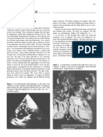 Letters To The Editor: Pulmonary Atresia With Intact Ventricular Septum