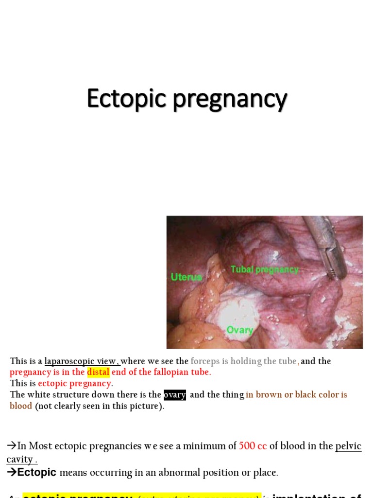 ectopic-pregnancy-important-pptx-implantation-human-embryo