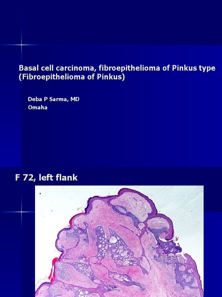 Basal Cell Carcinoma, Fibroepithelioma of Pinkus Type, F 72, Right Flank PDF