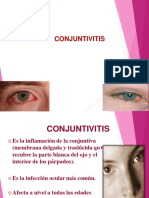 conjuntivitis