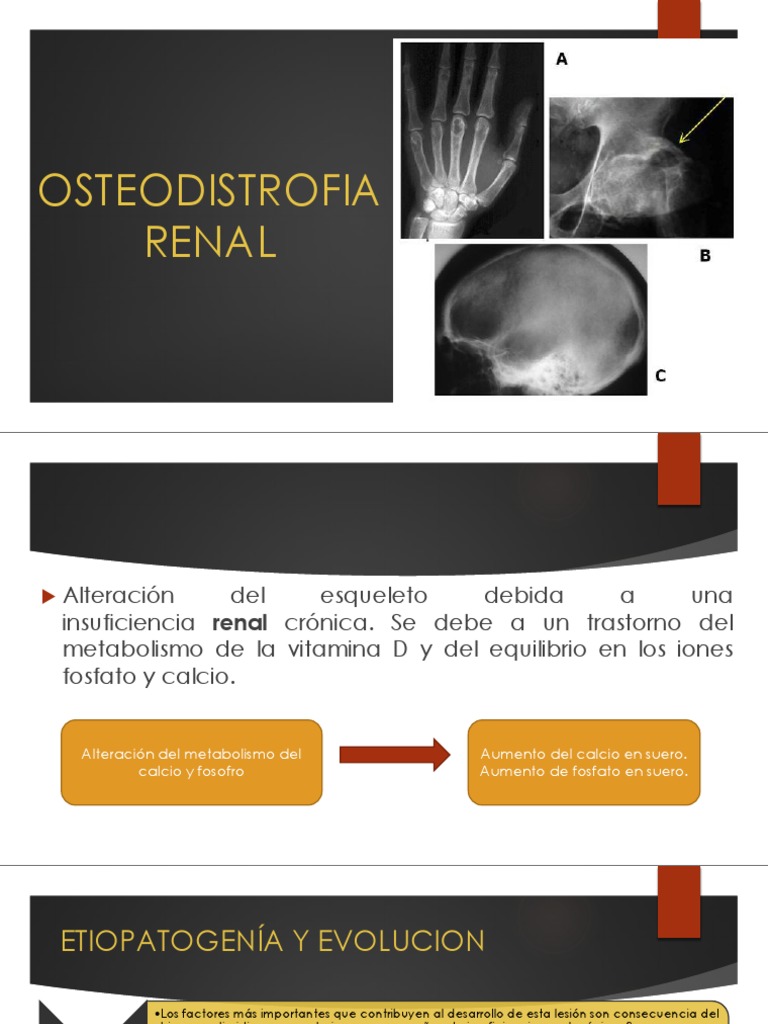 osteodistrofia-renal-causas-y-tratamiento-pdf